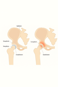 Heupgewricht met en zonder artrose: links een gezonde heup met een gladde heupkop en kraakbeen, rechts een heup met artrose waarbij het kraakbeen is versleten, bot op bot contact ontstaat en de pijnzone rood is gemarkeerd.