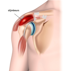 Anatomische illustratie van de schouder met een ontstoken slijmbeurs (bursitis). De slijmbeurs boven de schouderkop is rood gekleurd om irritatie en ontsteking te laten zien, tussen het acromion en de pezen van de rotator cuff.