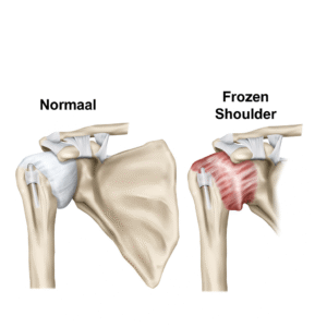 Vergelijking tussen een normale schouder en een frozen shoulder: verdikt en ontstoken gewrichtskapsel waardoor de schouder stijf en pijnlijk wordt.